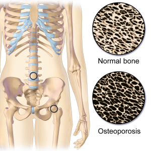 Magnesium en osteoporose